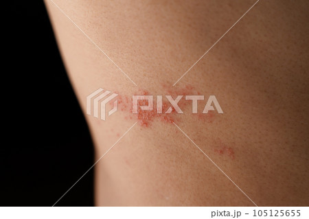 Man with shingles disease, skin infected with Herpes zoster, virus, Healthcare and medical. 105125655