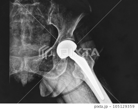 X-ray image of hip replacement surgery 105129359