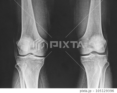 X-ray image of both knees 105129396