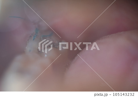 親知らず抜歯と縫合 親知らず抜歯と縫合 105143232