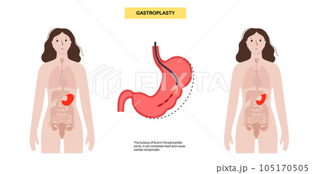 Endoscopic sleeve gastroplasty 105170505