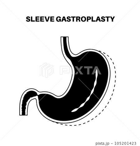 Endoscopic sleeve gastroplasty 105201423