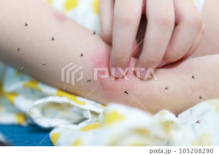 Little girl has skin rash allergy and itchy on her arm from mosquito bite 105208290