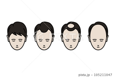 AGA、脱毛症が進行する男性のイラスト 105211047
