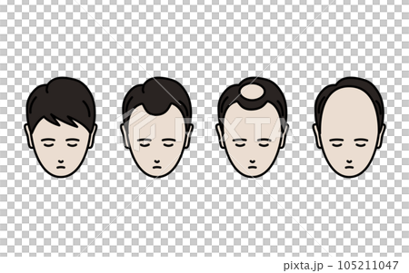 AGA、脱毛症が進行する男性のイラスト 105211047