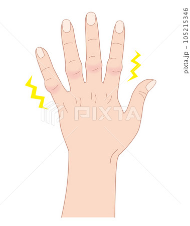 ブシャール結節 第二関節 腫れ 平面 イラスト カラー 透過 png 背景透明 105215346