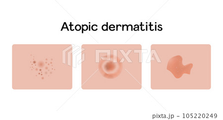 Atopic dermatitis examples vector illustration design, medical problems 105220249