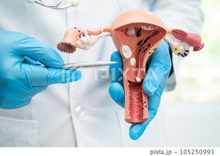Uterus, doctor holding anatomy model for study diagnosis and treatment in hospital. Uterus, doctor holding anatomy model for study diagnosis and treatment in hospital. 105250991