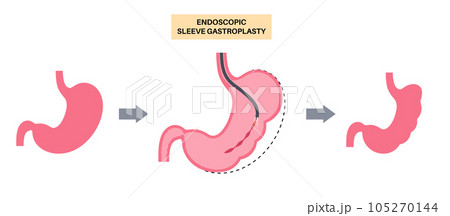 Endoscopic sleeve gastroplasty 105270144