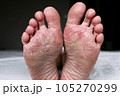 Close up of dry feet. Peeling and cracked foot. Fungal infection or athlete's foot, dry skin, dermatitis, eczema, psoriasis, sweaty feet or dehydration. Health care concept. 105270299