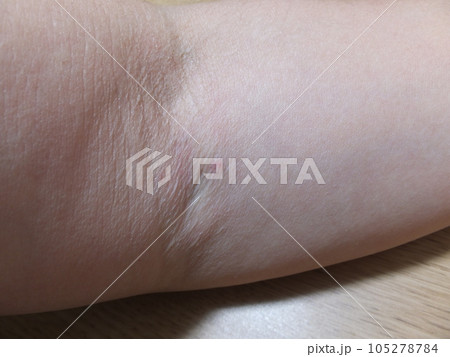 腕の点滴をした跡 腕の点滴をした跡 105278784