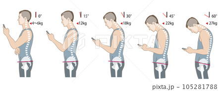 首の傾く角度と負荷、猫背と骨盤後傾の骨格図 105281788