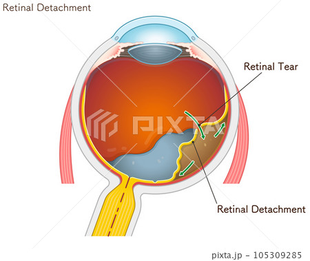 retinal tear・retinal detachment・eye・illustration 105309285
