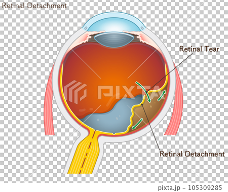 retinal tear・retinal detachment・eye・illustration 105309285