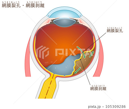 眼球・網膜裂孔・網膜剥離・イラスト 眼球・網膜裂孔・網膜剥離・イラスト 105309286