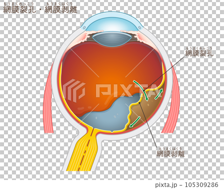 眼球・網膜裂孔・網膜剥離・イラスト 眼球・網膜裂孔・網膜剥離・イラスト 105309286
