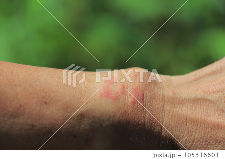 毛虫に刺された痕 105316601