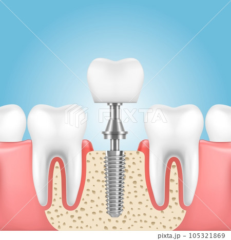 Tooth dental implant, vector dentistry, dentist and denture technologies. Human jaw with health teeth and prosthesis with implant crown, screw and abutment, dental medicine themes 105321869
