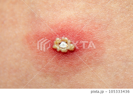 Treatment of ulcers from chicken pox. A large purulent sore chicken pox on the skin of a child, an allergic reaction in a person 105333436