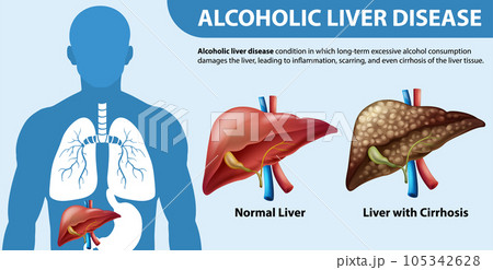 Informative poster of alcoholic liver disease Cirrhosis Informative poster of alcoholic liver disease Cirrhosis 105342628