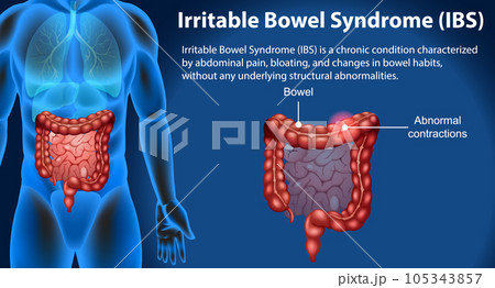 Irritable Bowel Syndrome (IBS) Infographic 105343857