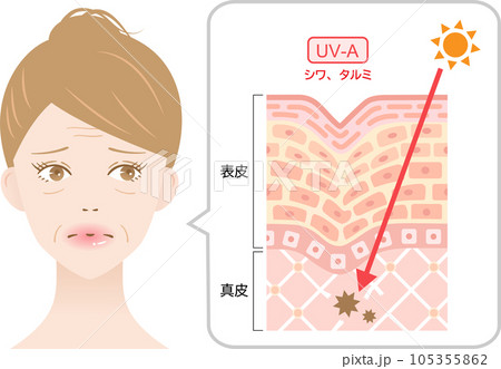 紫外線A波　しわ　たるみ　女性と肌の断面図 105355862