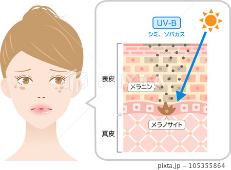 紫外線B波　シミ、ソバカス　女性と肌の断面図　 105355864