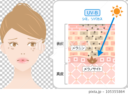 紫外線 B 波瑕疵、女性和皮膚的雀斑橫截面 105355864