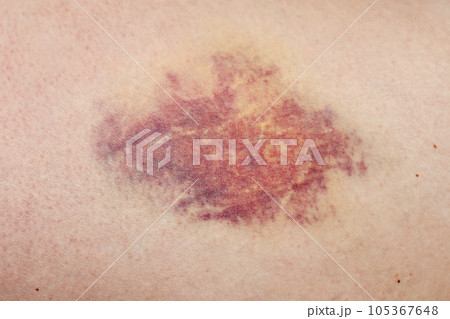 A bruise, a large hematoma on the human body. A bruise, a large hematoma on the human body. 105367648