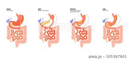 Bariatric surgery poster 105367801