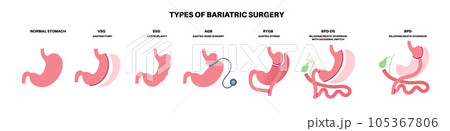 Bariatric surgery poster 105367806