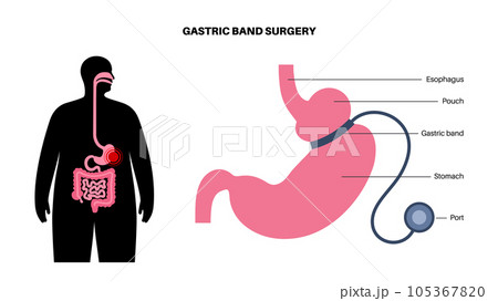 Gastric band poster Gastric band poster 105367820