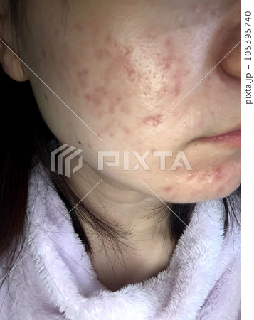 重症ニキビの女性 105395740
