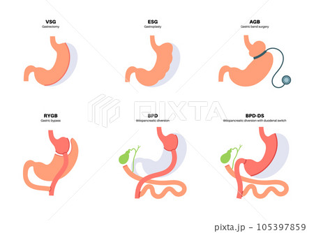Bariatric surgery poster 105397859