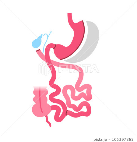 Biliopancreatic diversion procedure 105397865