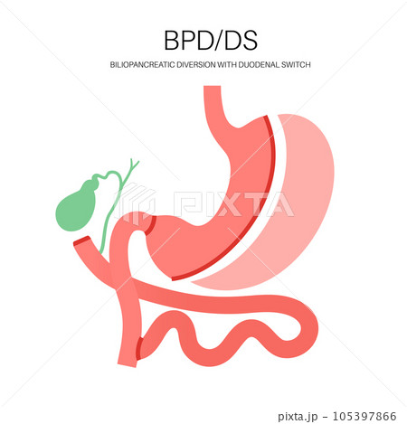 Biliopancreatic diversion procedure Biliopancreatic diversion procedure 105397866