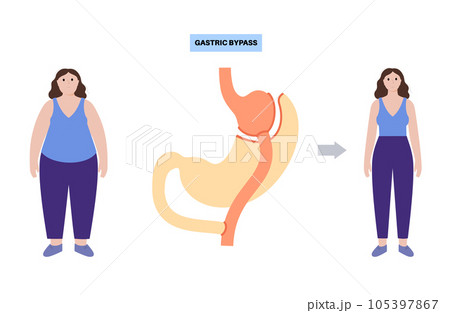 Gastric bypass surgery Gastric bypass surgery 105397867