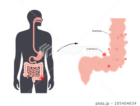 Diverticulitis and diverticulosis Diverticulitis and diverticulosis 105404634