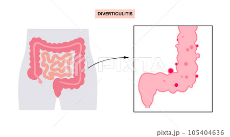 Diverticulitis and diverticulosis 105404636