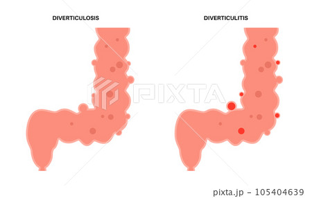 Diverticulitis and diverticulosis Diverticulitis and diverticulosis 105404639