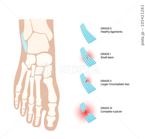 Sprained ankle injury 105421261