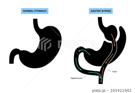 Gastric bypass surgery 105422982