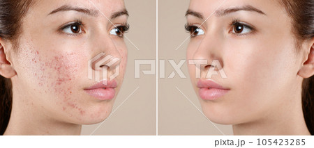 Teenage girl before and after acne treatment on beige background 105423285