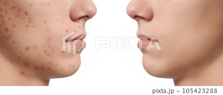 Teenager before and after acne treatment on white background, closeup 105423288