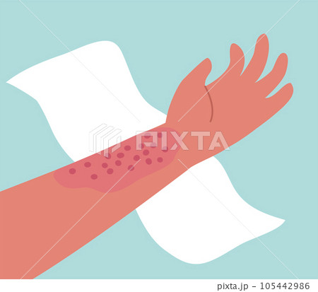 Dermatitis on the skin of a human hand Dermatitis on the skin of a human hand 105442986