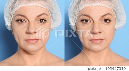 mature before after Mature woman before and after plastic surgery...の写真素材 [105447350] - PIXTA