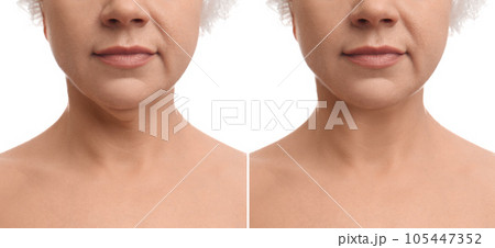 Mature woman before and after plastic surgery operation on white background, closeup Mature woman before and after plastic surgery operation on white background, closeup 105447352