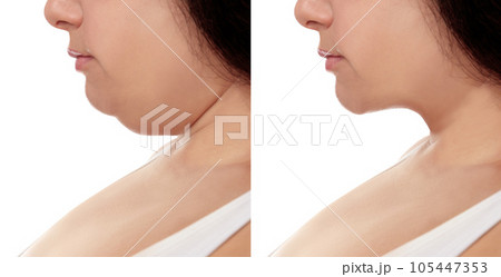 Woman before and after plastic surgery operation on white background, closeup. Double chin problem 105447353