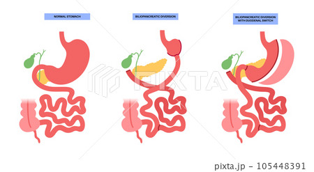 Biliopancreatic diversion procedure 105448391