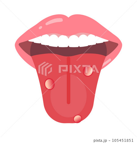 口内炎のある舌 105451851